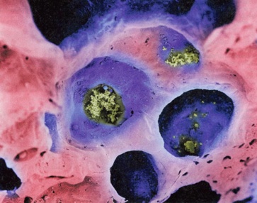 Dieselrusspartikel in der Lunge-Lennart Nilsson